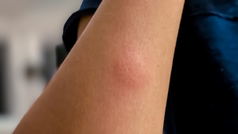 Mosquito Bite 800X451px LS