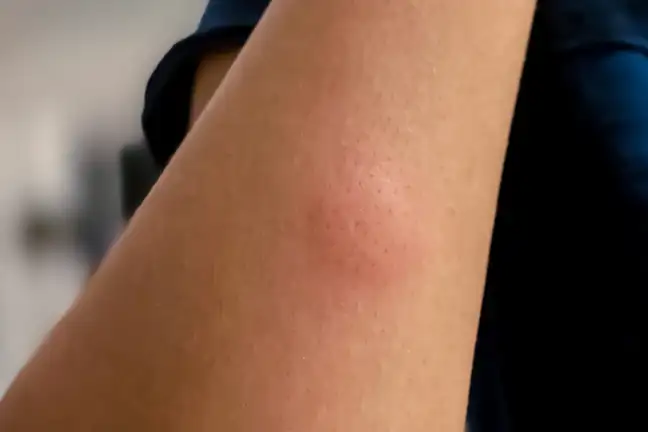 Mosquito Bite 800X451px LS